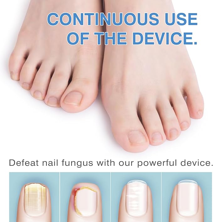 Laser Treatment for Nail Fungus