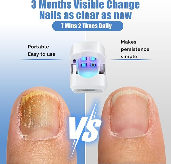 Laser Treatment for Nail Fungus