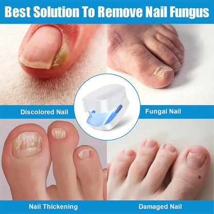 Laser Treatment for Nail Fungus